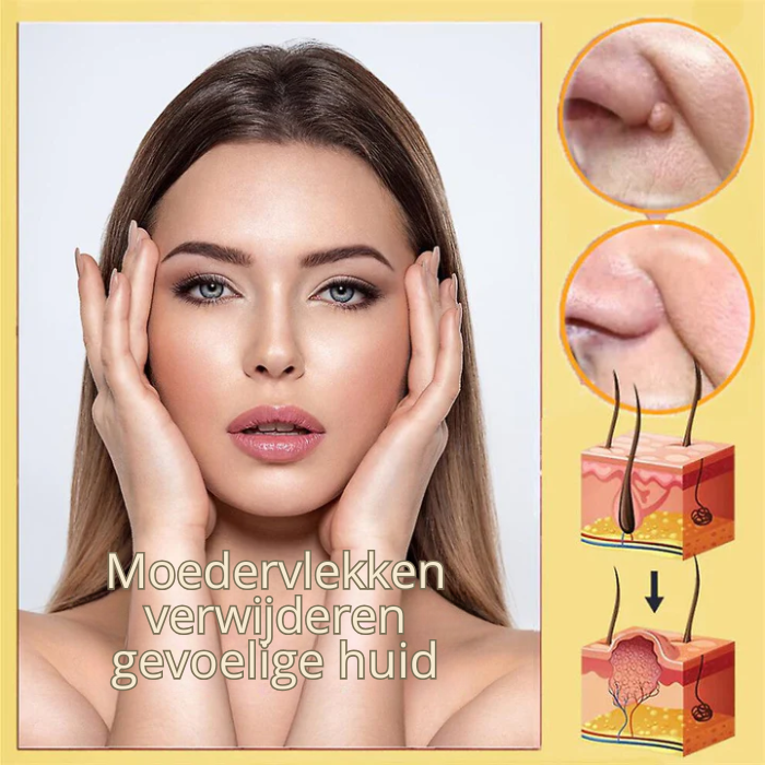 Bijenwesp Extract Verwijderaar – Voor Moedervlekken en Wratten – Ontstekingsremmend