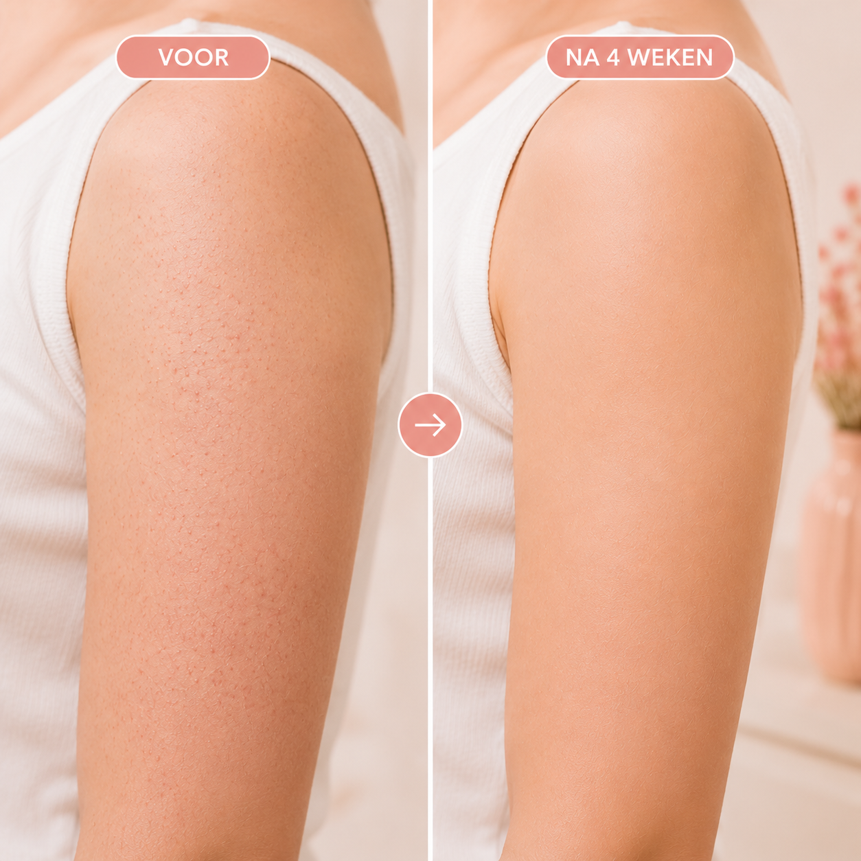 Fittershape Triple-Acid Complex – tegen keratosis pilaris